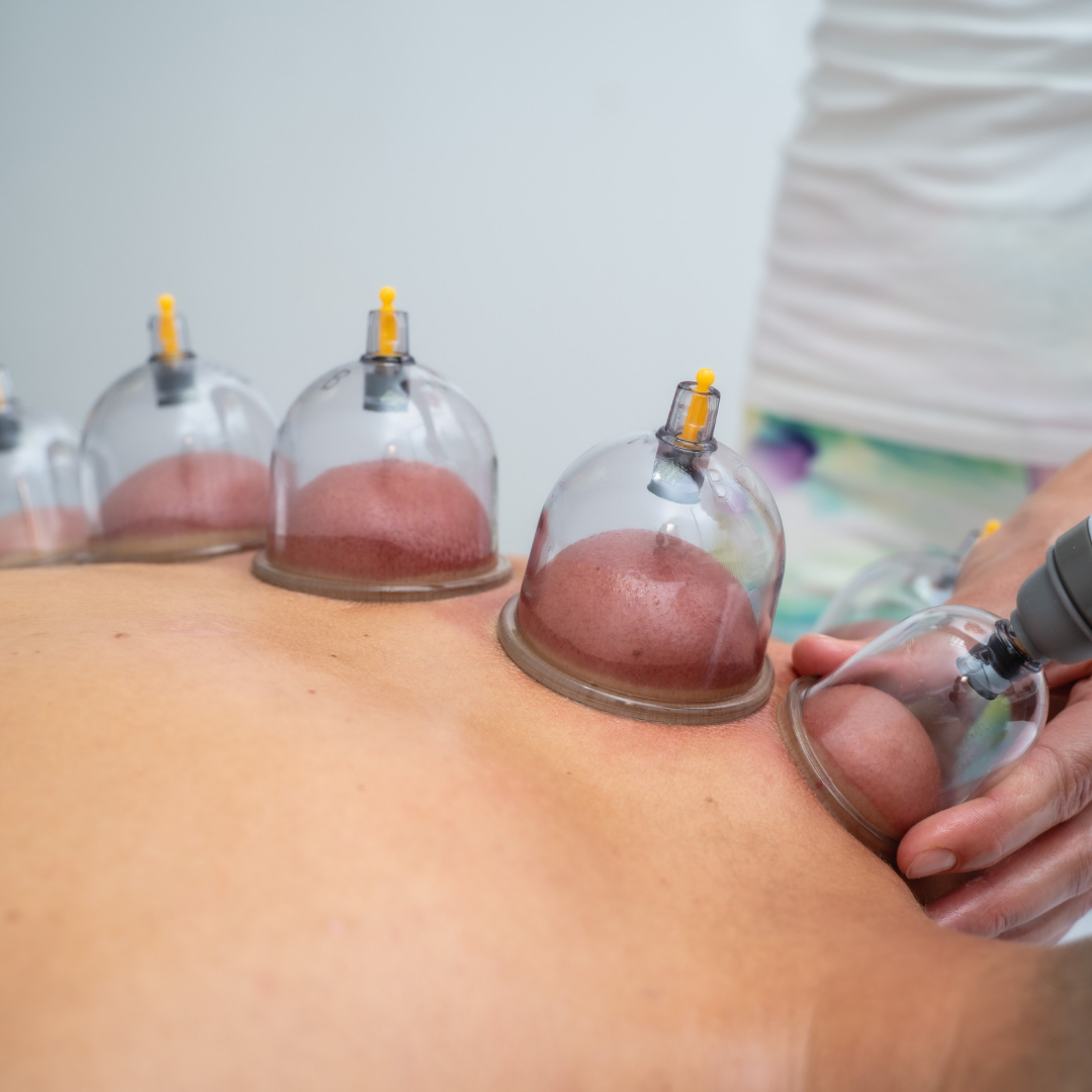 Cupping Therapy